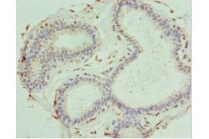Immunohistochemistry of paraffin-embedded human breast cancer using ABIN7166867 at dilution of 1:100 (PDXK antibody  (AA 1-312))