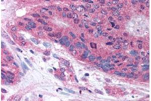 Human Colon Carcinoma (formalin-fixed, paraffin-embedded) stained with PLA2G3 antibody ABIN213634 at 10 ug/ml followed by biotinylated goat anti-rabbit IgG secondary antibody ABIN481713, alkaline phosphatase-streptavidin and chromogen. (PLA2G3 antibody  (Internal Region))