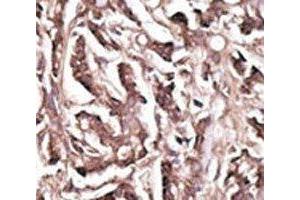 IHC analysis of FFPE human breast carcinoma tissue stained with the APG7 antibody (ATG7 antibody  (AA 284-313))