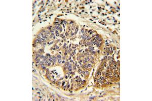 Formalin-fixed and paraffin-embedded human lung carcinoma reacted with HMGCS1 Antibody (C-term), which was peroxidase-conjugated to the secondary antibody, followed by DAB staining. (HMGCS1 antibody  (C-Term))