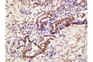 Formalin-fixed and paraffin embedded human lung carcinoma labeled with Rabbit Anti-CD361 Polyclonal Antibody, Unconjugated  at 1:200 followed by conjugation to the secondary antibody and DAB staining (EVI2B antibody  (AA 151-250))