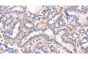 Immunohistochemistry of paraffin-embedded Human thyroid cancer using AMY2A Polyclonal Antibody at dilution of 1:50 (AMY2A antibody)