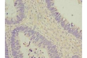 Immunohistochemistry of paraffin-embedded human ovarian cancer using ABIN7172903 at dilution of 1:100 (EIF2B2 antibody  (AA 1-351))