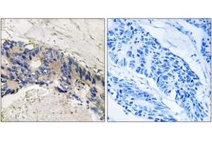 Immunohistochemistry analysis of paraffin-embedded human colon carcinoma tissue, using CA1 Antibody. (CA1 antibody  (AA 41-90))