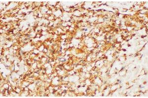 Immunohistochemistry of paraffin-embedded Human kidney cancer using HRAS Polycloanl Antibody at dilution of 1:200 (HRAS antibody)