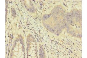 Immunohistochemistry of paraffin-embedded human colon cancer using ABIN7144423 at dilution of 1:100 (Apolipoprotein D antibody  (AA 21-189))