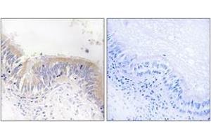 Immunohistochemistry analysis of paraffin-embedded human lung carcinoma tissue, using VGF Antibody. (VGF antibody  (AA 454-503))
