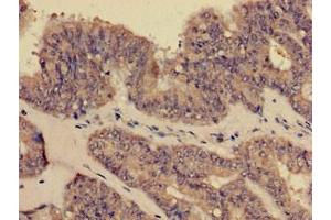 Immunohistochemistry of paraffin-embedded human endometrial cancer using ABIN7148409 at dilution of 1:100 (CD35 antibody  (AA 901-1095))