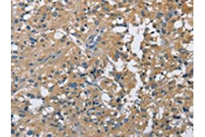 The image on the left is immunohistochemistry of paraffin-embedded Human thyroid cancer tissue using ABIN7128713(CAB39L Antibody) at dilution 1/40, on the right is treated with fusion protein.