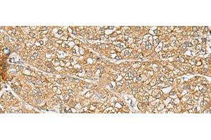 Immunohistochemistry of paraffin-embedded Human liver cancer tissue using C1orf112 Polyclonal Antibody at dilution of 1:110(x200) (C1orf112 antibody)