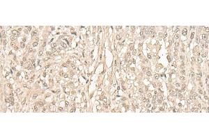 Immunohistochemistry of paraffin-embedded Human ovarian cancer tissue using FYTTD1 Polyclonal Antibody at dilution of 1:30(x200) (FYTTD1 antibody)