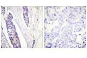 Immunohistochemistry analysis of paraffin-embedded human breast carcinoma tissue, using Tubulin β antibody. (TUBB3 antibody  (C-Term))