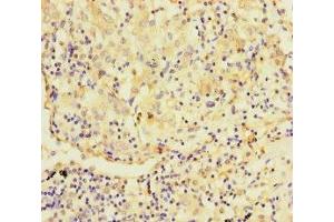 Immunohistochemistry of paraffin-embedded human lung cancer using ABIN7173003 at dilution of 1:100