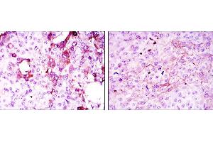 Immunohistochemical analysis of paraffin-embedded mammary cancer tissues (left) and lung cancer tissues (right) using TNFRSF11B mouse mAb with DAB staining.