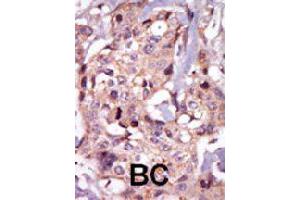 Formalin-fixed and paraffin-embedded human cancer tissue reacted with TEC polyclonal antibody  , which was peroxidase-conjugated to the secondary antibody, followed by AEC staining. (NR4A3 antibody  (Internal Region))
