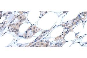 Immunohistochemistry of paraffin-embedded Human breast cancer tissue using ANGPTL6 Polyclonal Antibody at dilution of 1:55(x200) (ANGPTL6 antibody)