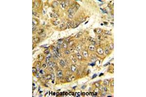 Formalin-fixed and paraffin-embedded human hepatocarcinoma reacted with LTA Antibody (Center), which was peroxidase-conjugated to the secondary antibody, followed by DAB staining. (LTA antibody  (Middle Region))