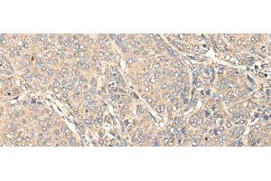 Immunohistochemistry of paraffin-embedded Human liver cancer tissue using C1orf106 Polyclonal Antibody at dilution of 1:80(x200)
