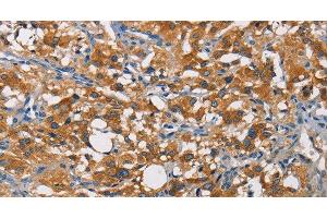 Immunohistochemistry of paraffin-embedded Human thyroid cancer tissue using CRTAM Polyclonal Antibody at dilution of 1:60