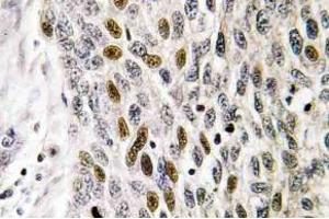 Immunohistochemistry (IHC) analyzes of ATF-1 antibody in paraffin-embedded human lung carcinoma tissue. (AFT1 antibody)