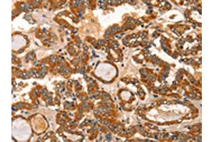 The image on the left is immunohistochemistry of paraffin-embedded Human thyroid cancer tissue using ABIN7129834(IKZF3 Antibody) at dilution 1/60, on the right is treated with fusion protein.