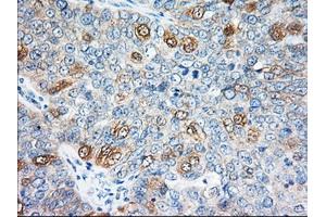 Immunohistochemical staining of paraffin-embedded Adenocarcinoma of Human colon tissue using anti-EIF2S1 mouse monoclonal antibody. (EIF2S1 antibody)