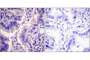 Immunohistochemistry analysis of paraffin-embedded human lung carcinoma tissue, using Caspase 9 (Cleaved-Asp315) Antibody.