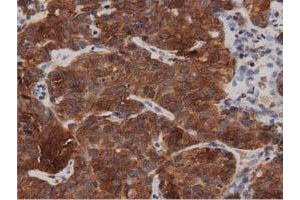 Immunohistochemical staining of paraffin-embedded Adenocarcinoma of Human breast tissue using anti-DNAJA2 mouse monoclonal antibody.