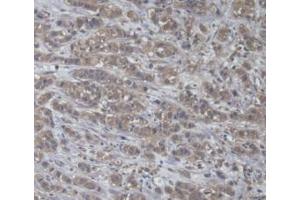Detection of a4GALT in Human Breast Cancer Tissue using Polyclonal Antibody to Alpha-1,4-Galactosyltransferase (a4GALT) (A4GALT antibody  (AA 44-353))
