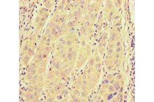 Immunohistochemistry of paraffin-embedded human liver cancer using ABIN7168958 at dilution of 1:100 (SRRM2 antibody  (AA 248-462))