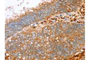 The image on the left is immunohistochemistry of paraffin-embedded Human cervical cancer tissue using ABIN7130778(PTPN7 Antibody) at dilution 1/30, on the right is treated with fusion protein. (PTPN7 antibody)