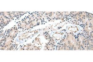 Immunohistochemistry of paraffin-embedded Human prost at e cancer tissue using S100A16 Polyclonal Antibody at dilution of 1:25(x200) (S100A16 antibody)