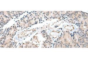 Immunohistochemistry of paraffin-embedded Human prost at e cancer tissue using S100A16 Polyclonal Antibody at dilution of 1:25(x200)