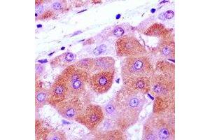 Immunohistochemical analysis of NRAGE staining in human liver cancer formalin fixed paraffin embedded tissue section.