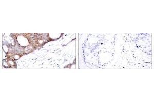 Immunohistochemical analysis of paraffin- embedded human breast carcinoma tissue using GSK3α (phospho-Ser21) antibody (E011007). (GSK3 alpha antibody  (pSer21))