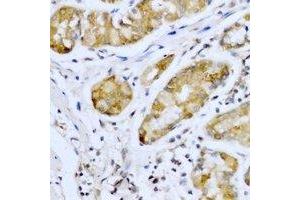 Immunohistochemical analysis of SMYD4 staining in human stomach cancer formalin fixed paraffin embedded tissue section. (SMYD4 antibody)
