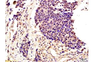 Formalin-fixed and paraffin embedded human lung cancer labeled with Anti-SNAI2/SLUG Polyclonal Antibody, Unconjugated (ABIN685747) followed by conjugation to the secondary antibody and DAB staining (SLUG antibody  (AA 5-120))