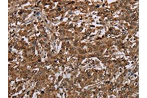 The image on the left is immunohistochemistry of paraffin-embedded Human liver cancer tissue using ABIN7192743(TBX5 Antibody) at dilution 1/35, on the right is treated with synthetic peptide. (T-Box 5 antibody)