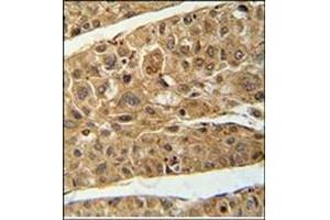 Immunohistochemistry analysis in Formalin Fixed and Paraffin Embedded Human hepatocarcinoma using RT4I1 Antibody (C-term) followed by peroxidase conjugation of the secondary antibody and DAB staining. (RTN4IP1 antibody  (C-Term))