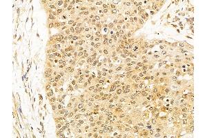 ABIN6263806 and ABIN6273061 at 1/100 staining Human esophageal cancer by IHC-P.