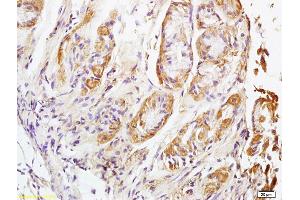 Formalin-fixed and paraffin embedded human lung carcinoma labeled with Rabbit Anti NALP4 Polyclonal Antibody, Unconjugated (ABIN872353) at 1:200 followed by conjugation to the secondary antibody and DAB staining (NLRP4 antibody  (AA 351-450))