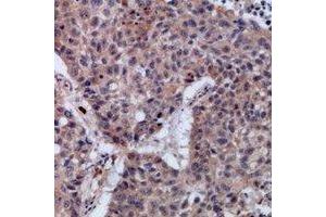 Immunohistochemical analysis of SETMAR staining in human lung cancer formalin fixed paraffin embedded tissue section.