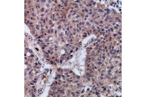 Immunohistochemical analysis of SETMAR staining in human lung cancer formalin fixed paraffin embedded tissue section. (SETMAR antibody)