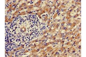 Immunohistochemistry of paraffin-embedded human liver cancer using ABIN7142472 at dilution of 1:100 (ALDH9A1 antibody  (AA 12-144))