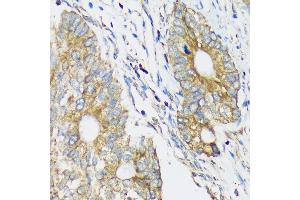 Immunohistochemistry of paraffin-embedded Human colon carcinoma using CLCC1 Rabbit pAb (ABIN7266333) at dilution of 1:100 (40x lens). (CLCC1 antibody  (AA 302-501))