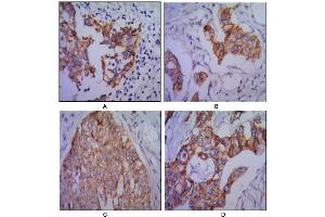 Immunohistochemical analysis of paraffin-embedded human lung cancer (A), colon cancer (B), ovarian cancer (C) and mammary cancer(D), using CDH2 antibody with DAB staining. (N-Cadherin antibody)