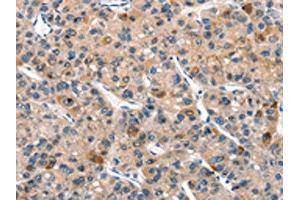 The image on the left is immunohistochemistry of paraffin-embedded Human liver cancer tissue using ABIN7190518(DUSP2 Antibody) at dilution 1/30, on the right is treated with synthetic peptide. (DUSP2 antibody)