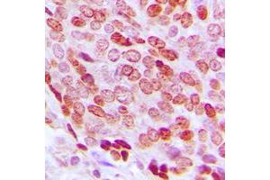 Immunohistochemical analysis of FOXD3 staining in human prostate cancer formalin fixed paraffin embedded tissue section. (FOXD3 antibody  (Center))