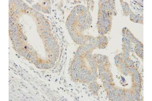 IHC-P Image Immunohistochemical analysis of paraffin-embedded human colon carcinoma, using PDYN, antibody at 1:250 dilution.