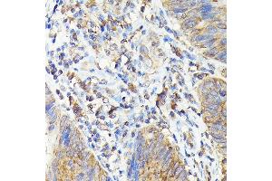 Immunohistochemistry of paraffin-embedded human colon carcinoma using T Rabbit pAb (ABIN3022236, ABIN3022237, ABIN3022238, ABIN1513586 and ABIN6218687) at dilution of 1:100 (40x lens). (TAP2 antibody  (AA 430-680))